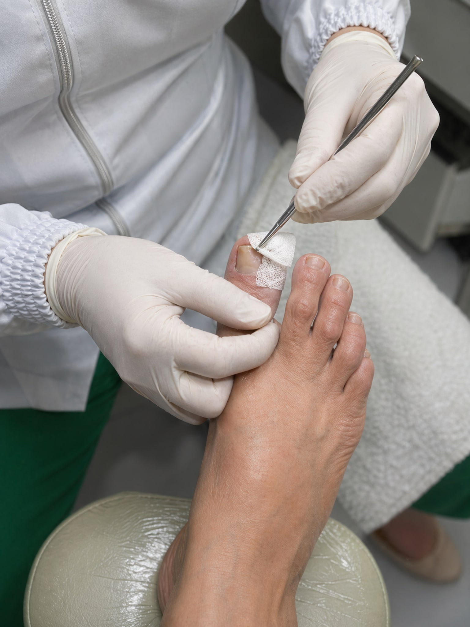 Bandagem e instrumental em uso durante atendimento na ZL Podologia Fortaleza - kit individualizado por paciente